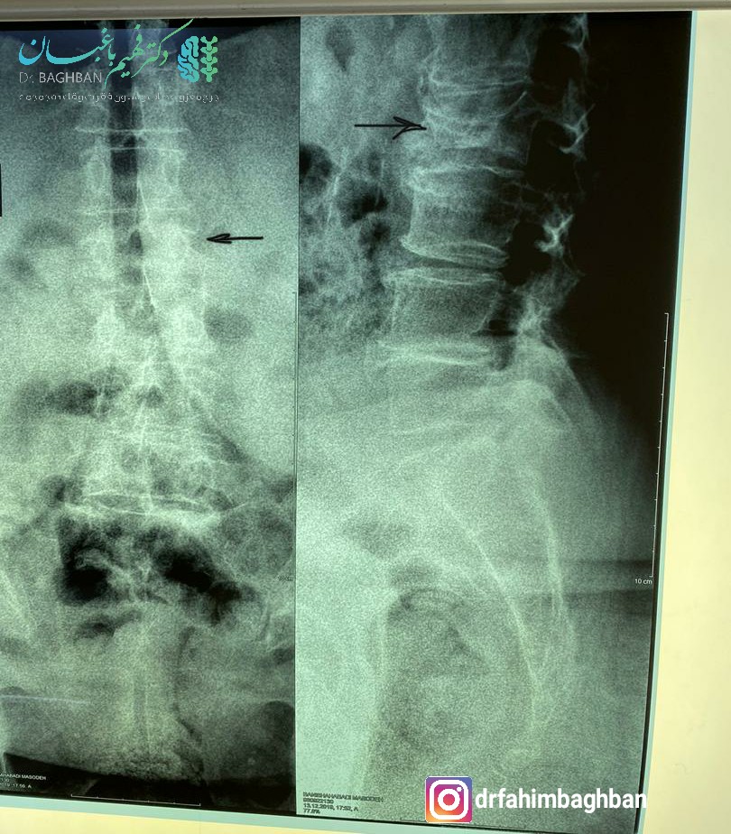 شکستگی مهره کمر