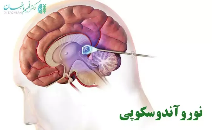 نورواندوسکوپی