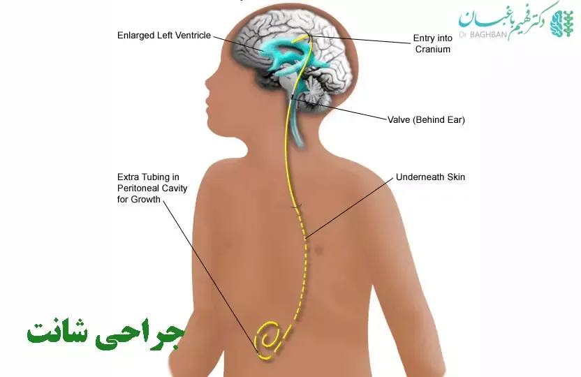 شنت‌گذاری مغزی