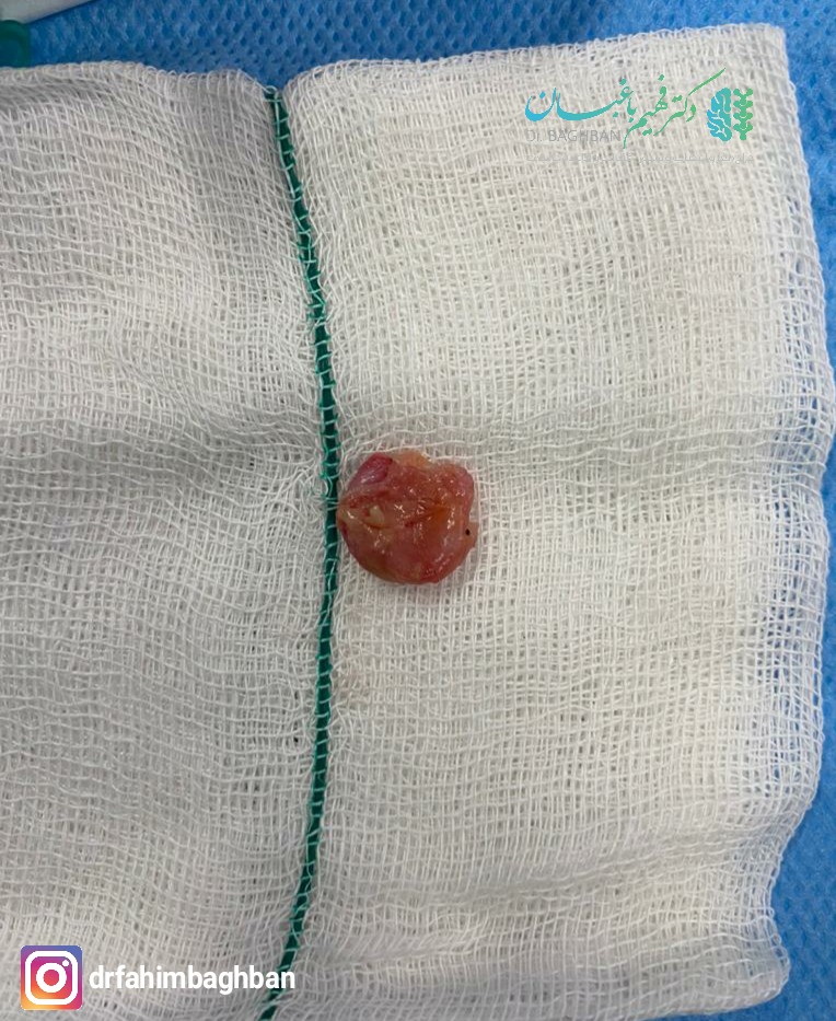 کیست سینوویال کمر