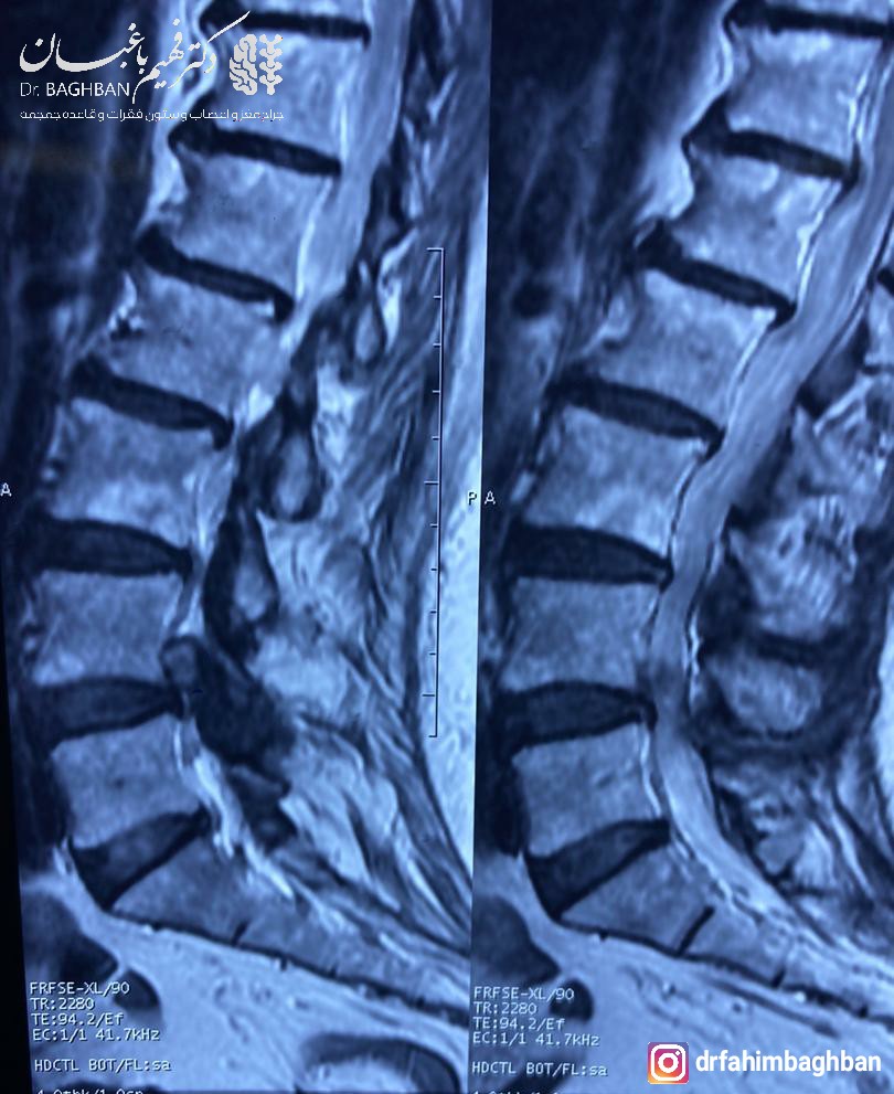 ام آر آی کیست سینوویال کمر