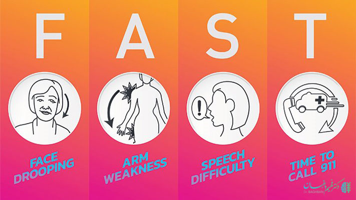 fast در سکته مغز