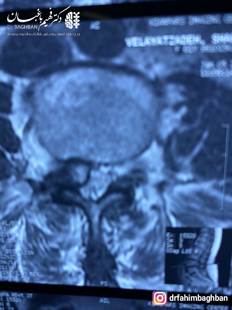 درمان کیست سینوویال کمر