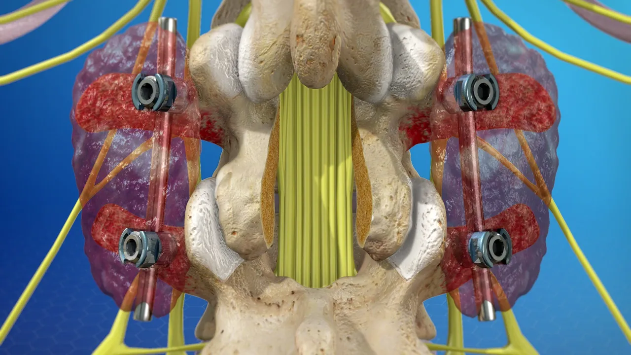 جراحی فیوژن ستون فقرات