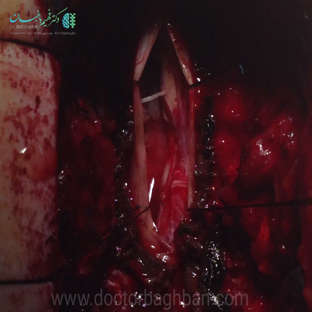 جراحی نورومانیتورینگ تومور مننژیومای نخاع