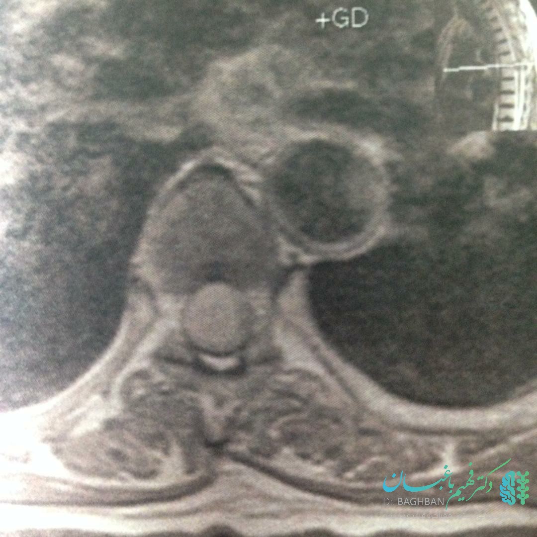 ام ار آی تومورمننژیومای نخاع