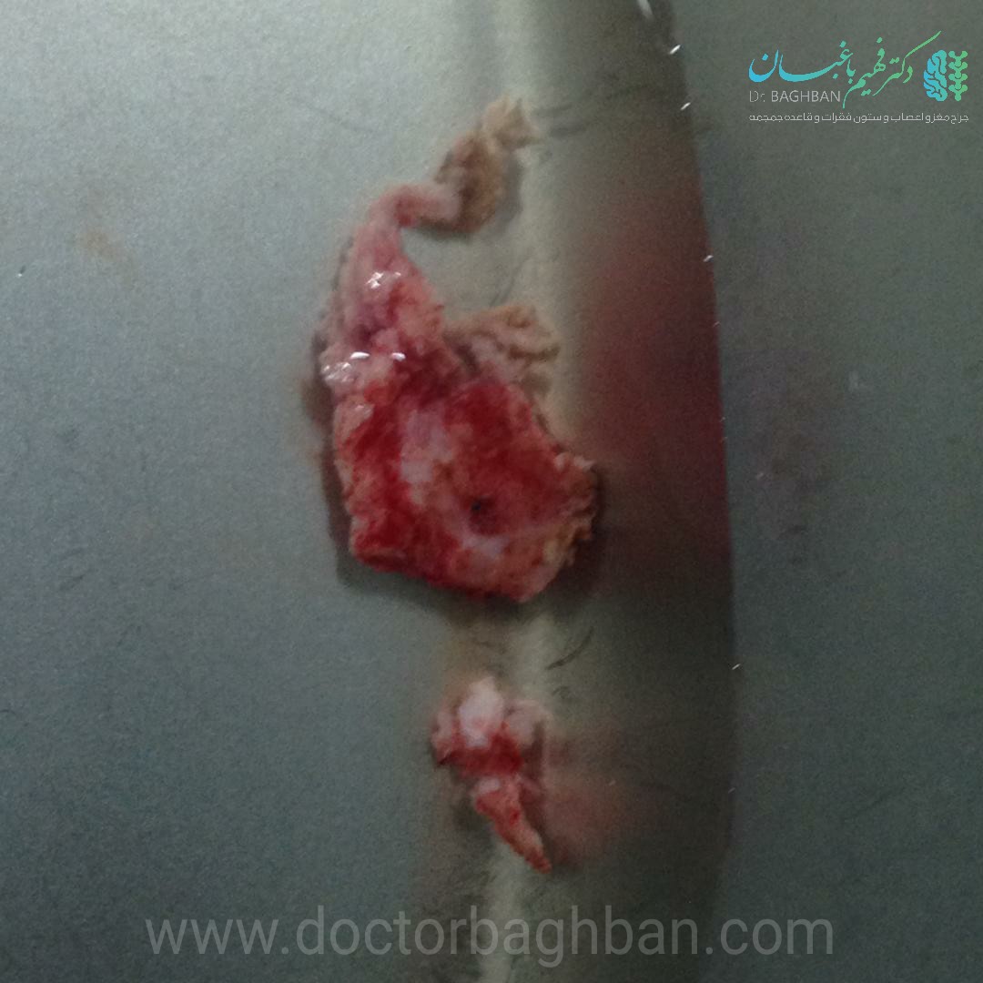 تومور مننژیومای نخاع