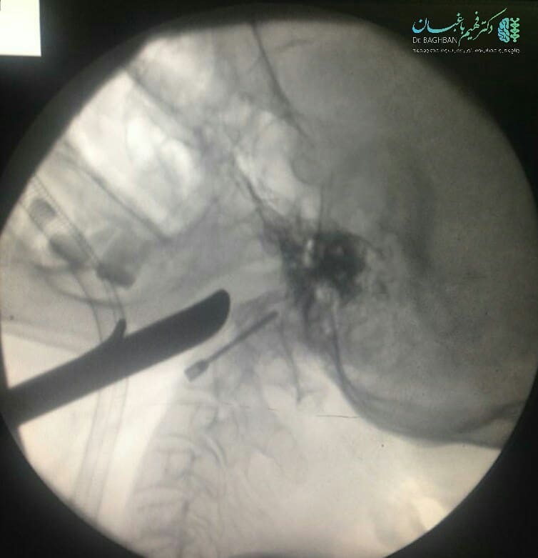جراحی شکستگی مهره گردن