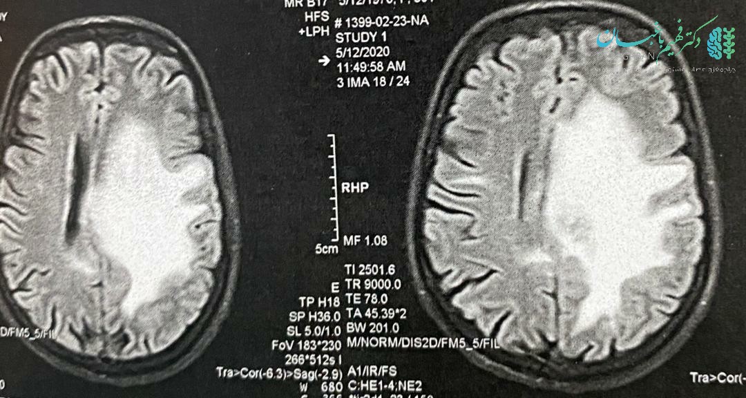 تومور متاستاتیک مغزی