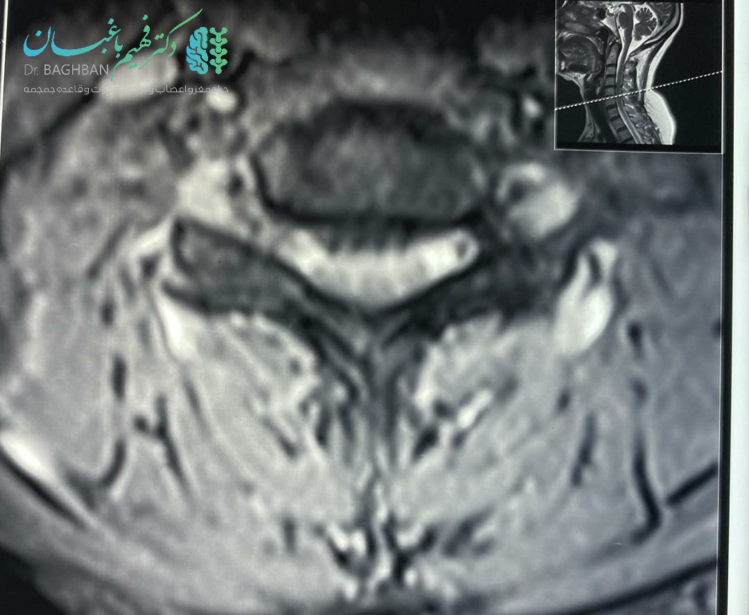 جراحی دیسک گردن