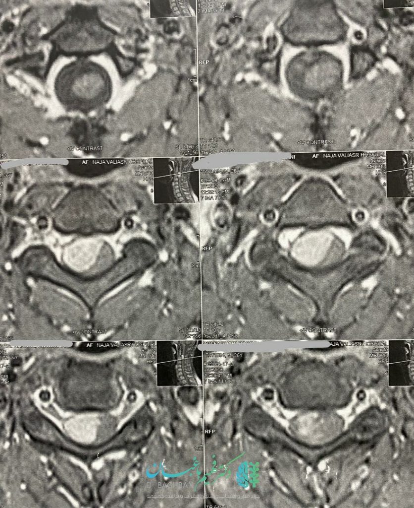 جراحی تومور مننژیومای نخاع گردن