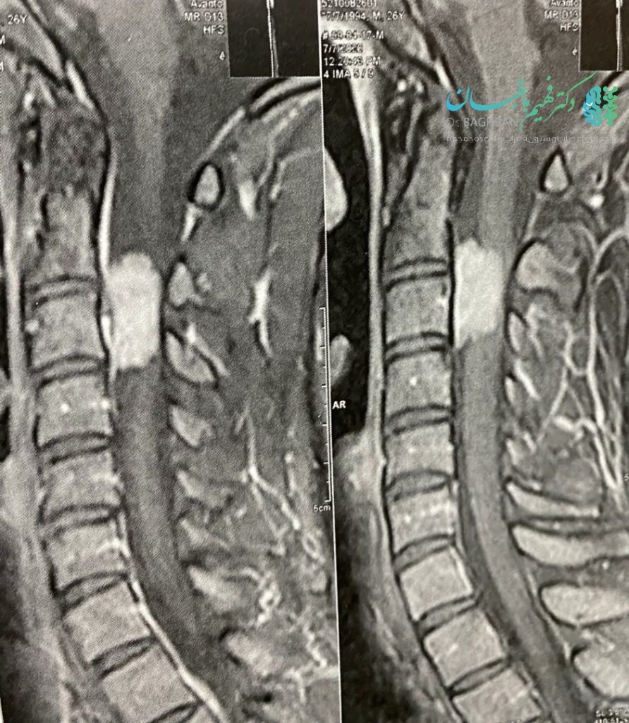 تومور مننژیومای نخاع گردن