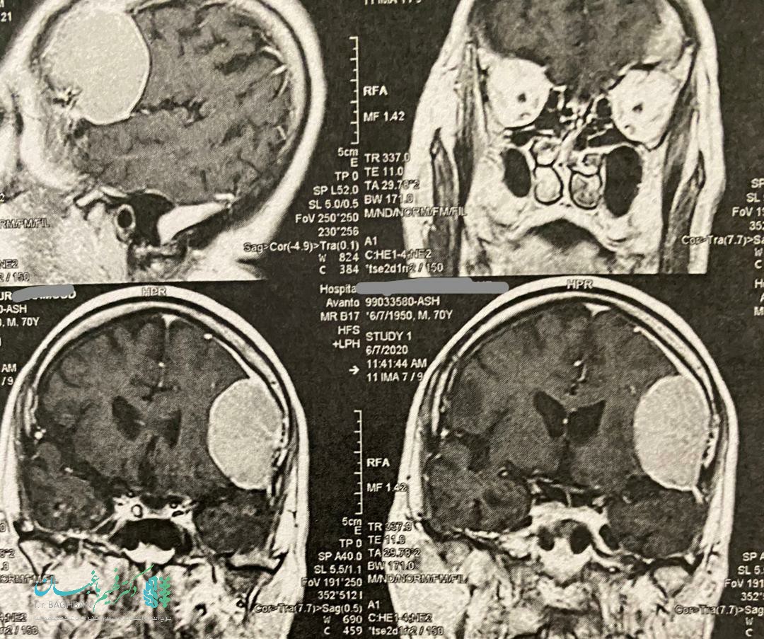 تومور مننژیوما