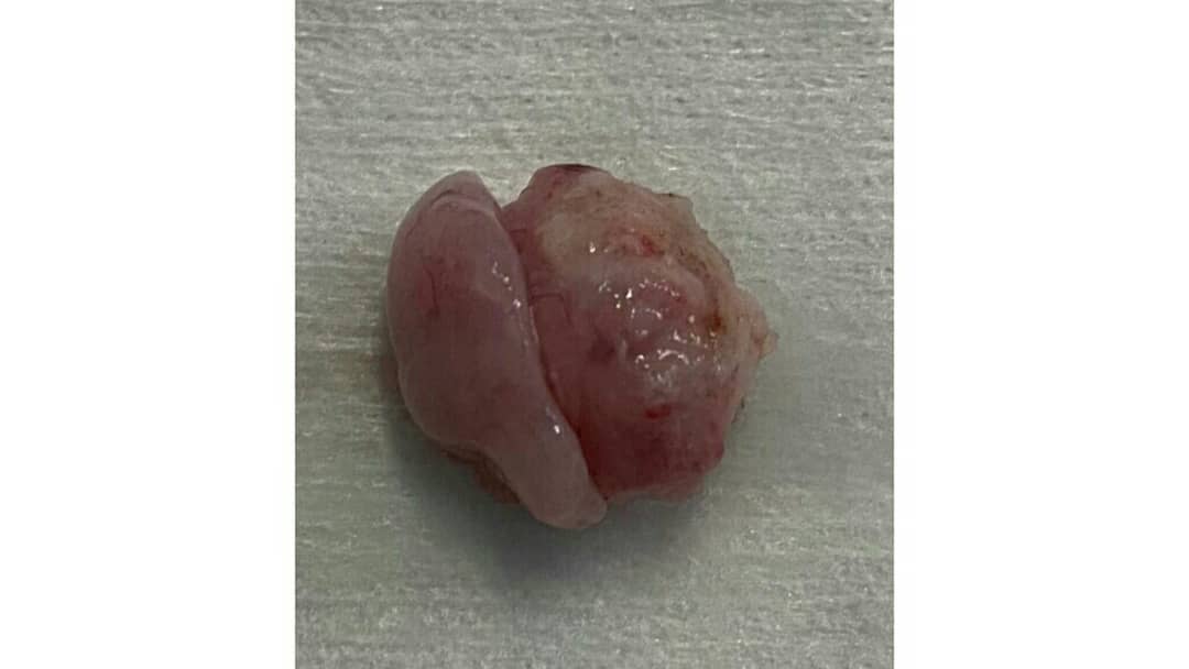 جراحی تومور مننژیومای سرویکال