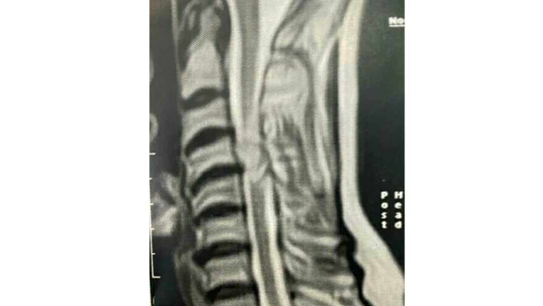 جراحی تومور نخاع گردن