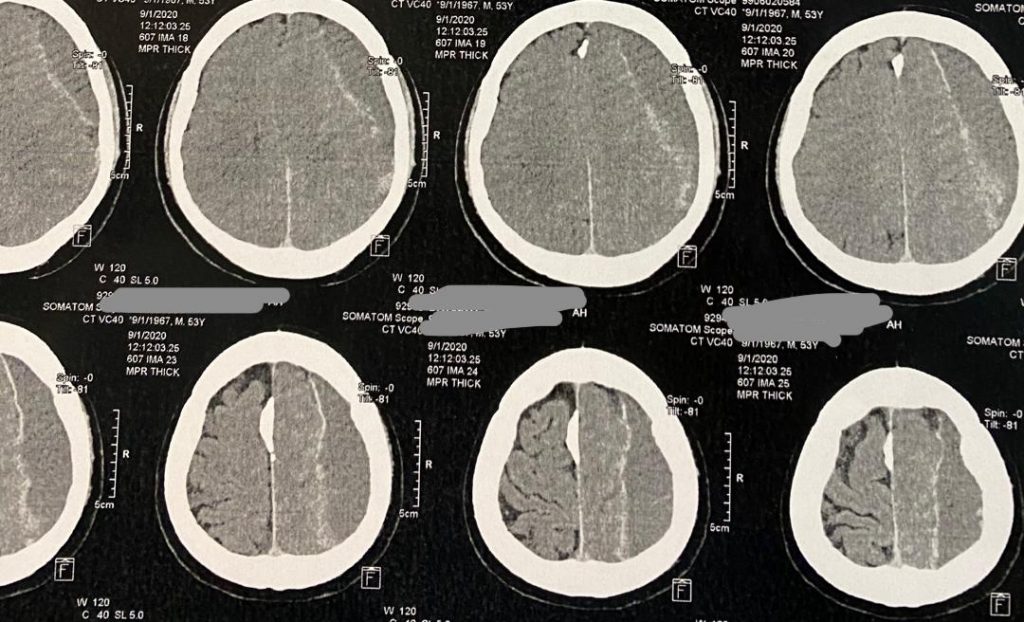 جراحی هماتوم مغزی