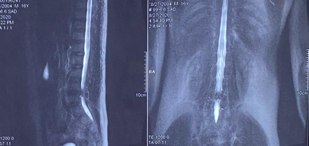 پارگی دیسک کمر در آقای 17 ساله