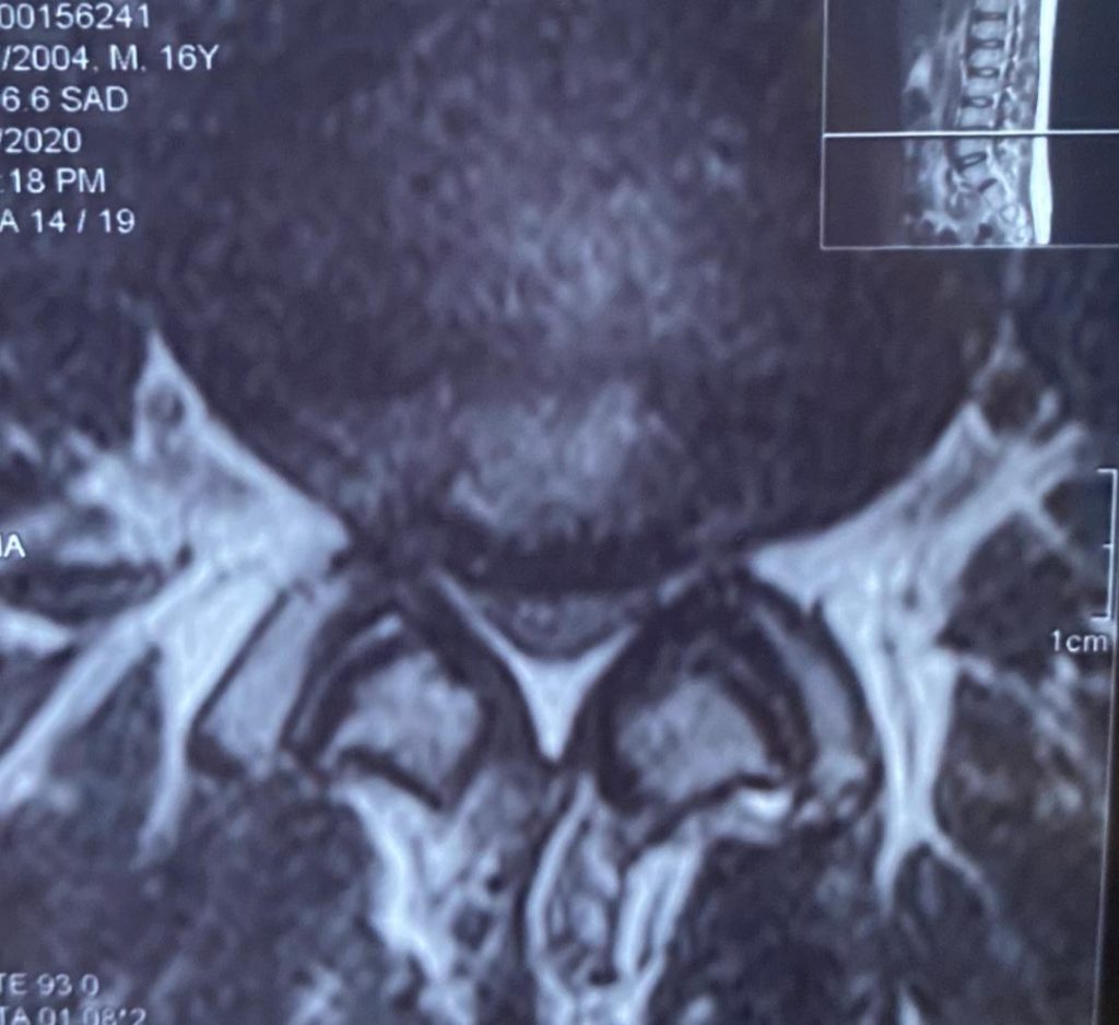 جراحی پارگی دیسک کمر