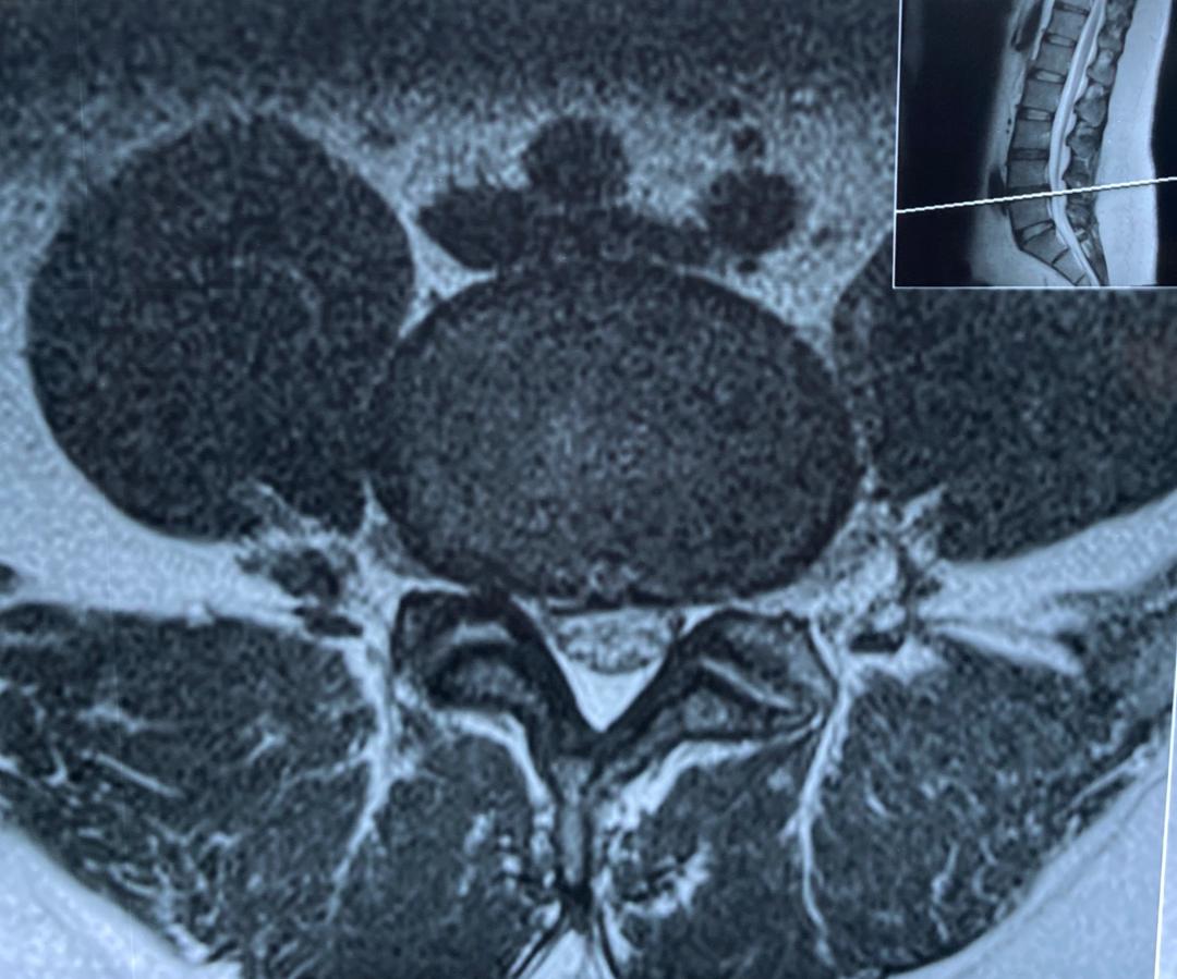تصاویر ام ار ای دیسک کمر
