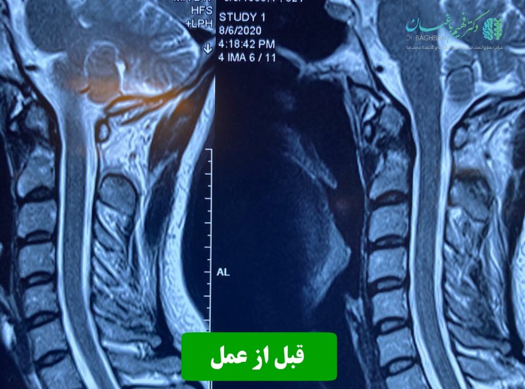 قبل از عمل شکستگی مهره گردن