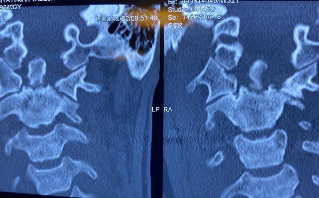 قبل از عمل شکستگی مهره گردن