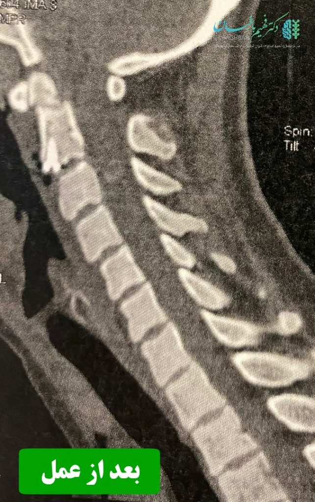 بعد از عمل شکستگی مهره گردن