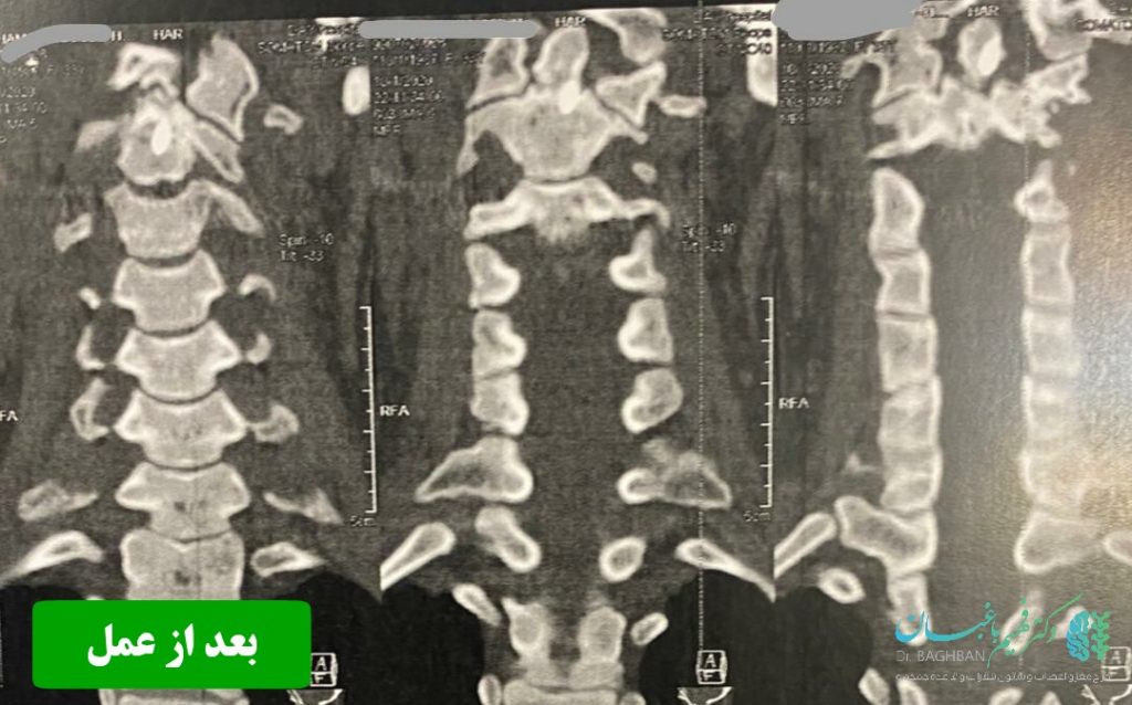 بعد از عمل شکستگی مهره گردن