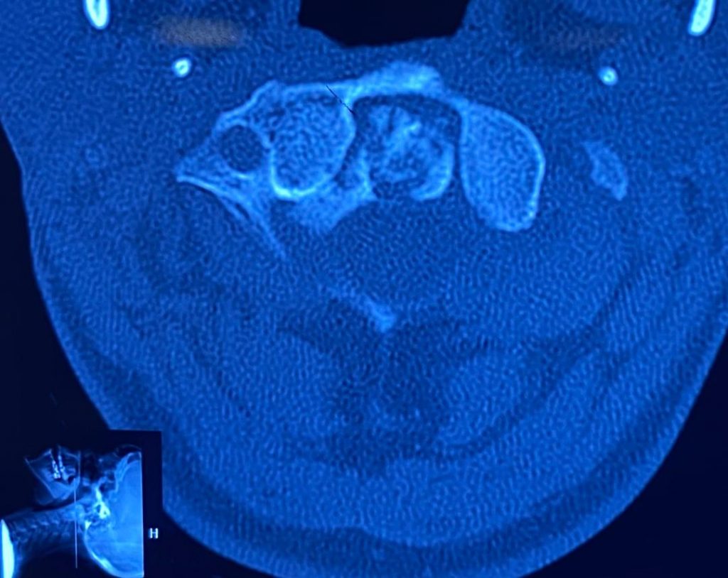 قبل از عمل شکستگی مهره گردن