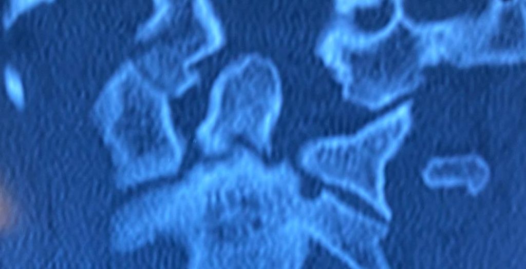 قبل از عمل شکستگی مهره گردن