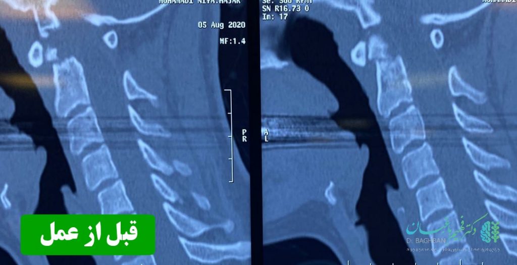 قبل از عمل شکستگی مهره گردن