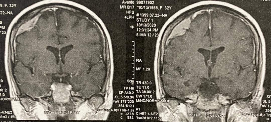 جراحی مننژیومای فرونتال