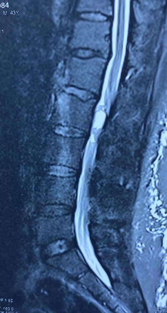 تومور نخاع کمری