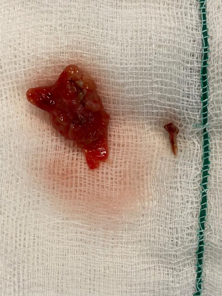 تومور نخاع کمری