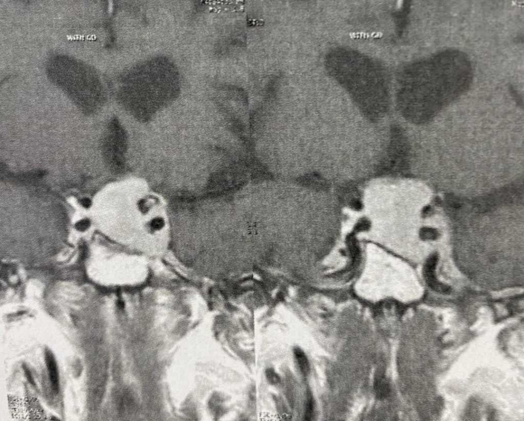 تومور هیپوفیز