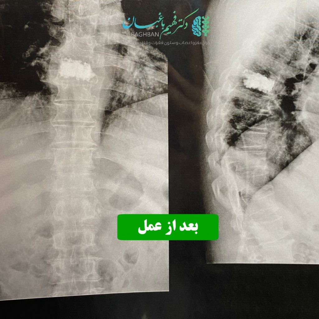 جراحی تومور همانژیوما