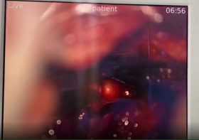 عمل جراحی ميكروسكوپيک ديسک كمر