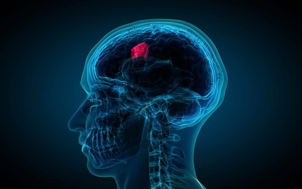 کدام تومور مغزی خطرناک است؟