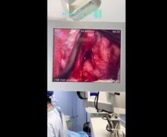 مننژیومای فالكس سربری