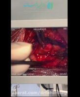 جراحی تومور شوانوما