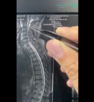 درمان تنگی کانال گردن