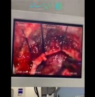 تومور مننژیومای سی پی انگل سمت چپ