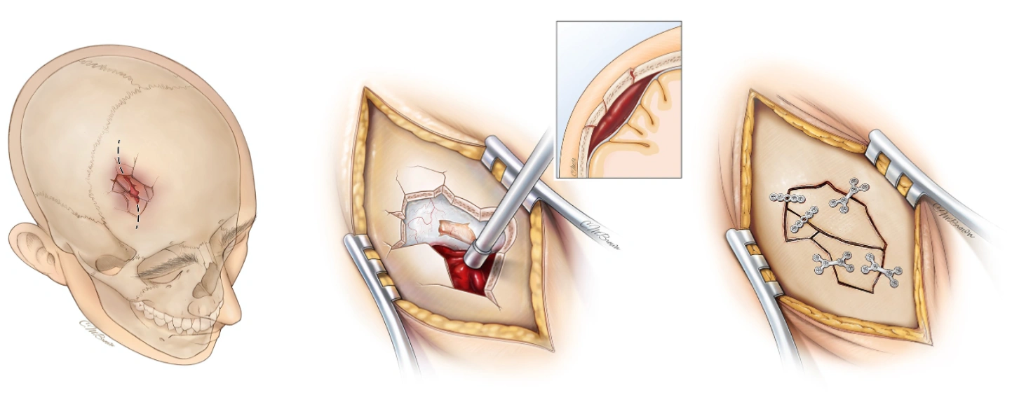 شکستگی جمجمه